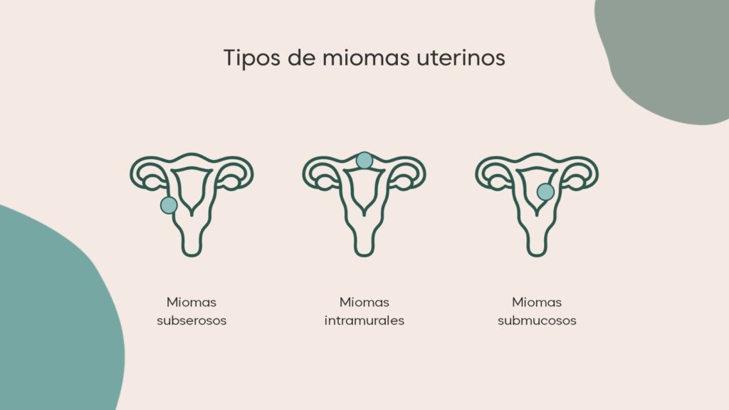 tipos de miomas uterinos fertilidad